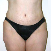 Abdominoplasty 19