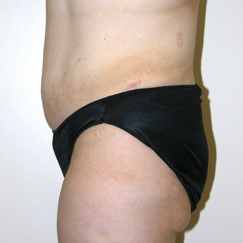 Abdominoplasty 19 After Photo