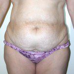 Abdominoplasty 19 Before Photo - 9