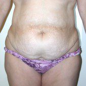 Abdominoplasty 19