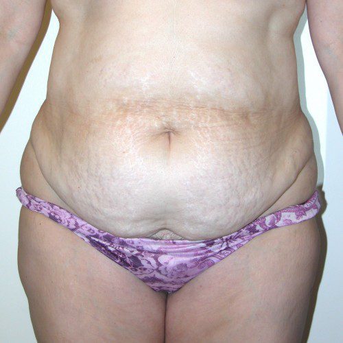 Abdominoplasty 19 Before Photo 