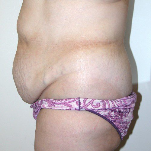 Abdominoplasty 19 Before Photo