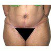 Abdominoplasty 20 After Photo Thumbnail