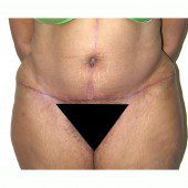 Abdominoplasty 20