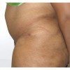 Abdominoplasty 20 After Photo Thumbnail