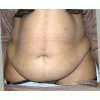 Abdominoplasty 20 Before Photo Thumbnail