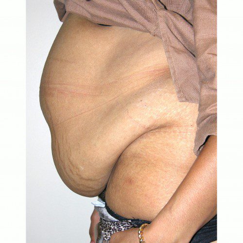 Abdominoplasty 20 Before Photo