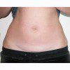 Mini-Abdominoplasty 21 After Photo Thumbnail