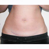 Mini-Abdominoplasty 21