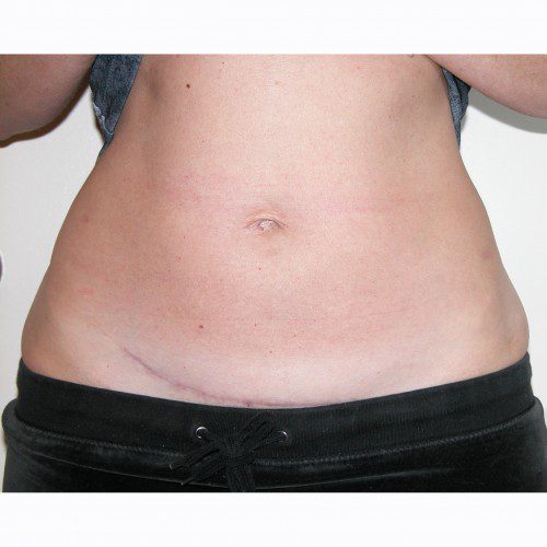 Mini-Abdominoplasty 21 After Photo 