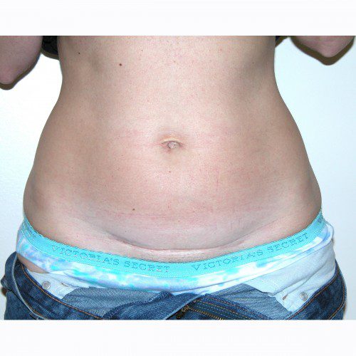 Mini-Abdominoplasty 21 Before Photo 