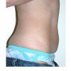 Mini-Abdominoplasty 21 Before Photo Thumbnail