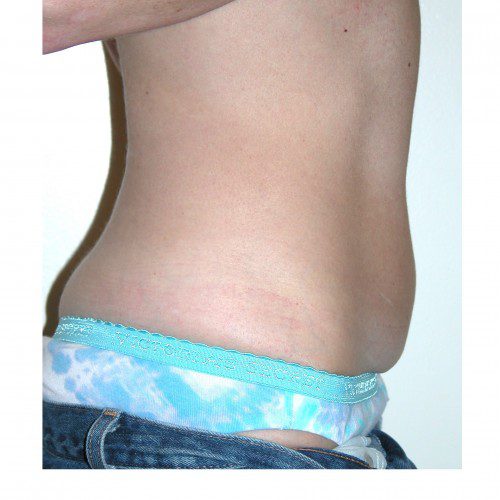 Mini-Abdominoplasty 21 Before Photo