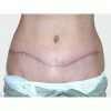 Abdominoplasty 22 After Photo Thumbnail