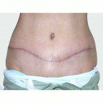 Abdominoplasty 22 After Photo - 6