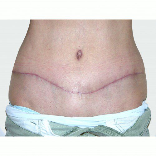 Abdominoplasty 22 After Photo 