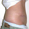 Abdominoplasty 22 After Photo Thumbnail