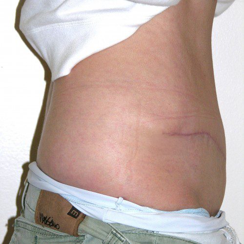 Abdominoplasty 22 After Photo