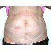 Abdominoplasty 22 Before Photo Thumbnail