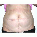 Abdominoplasty 22 Before Photo - 7