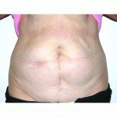 Abdominoplasty 22
