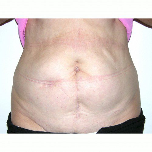 Abdominoplasty 22 Before Photo 