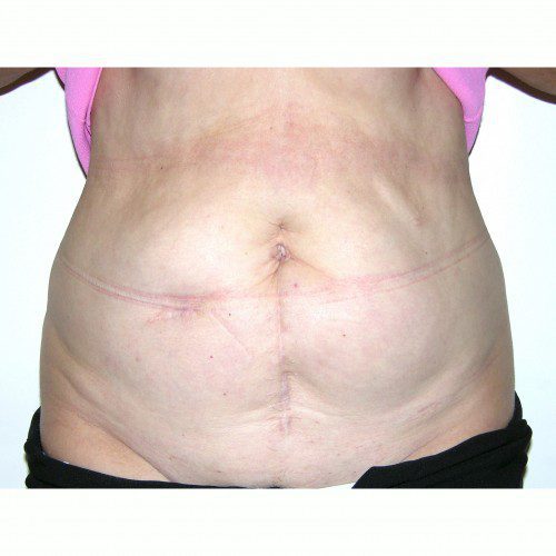 Abdominoplasty 11 Before Photo 