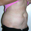 Abdominoplasty 22 Before Photo Thumbnail