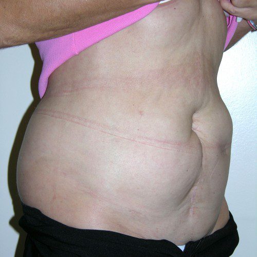 Abdominoplasty 22 Before Photo