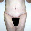 Abdominoplasty 23 After Photo Thumbnail
