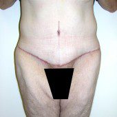 Abdominoplasty 23