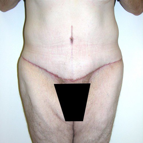 Abdominoplasty 23 After Photo 