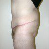 Abdominoplasty 23 After Photo Thumbnail