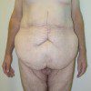 Abdominoplasty 23 Before Photo Thumbnail