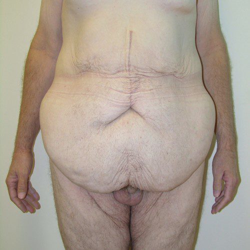 Abdominoplasty 23 Before Photo 