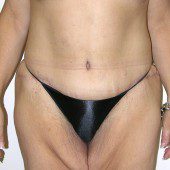 Abdominoplasty 24