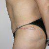 Abdominoplasty 24 After Photo Thumbnail