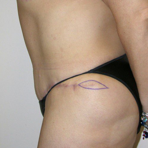 Abdominoplasty 24 After Photo