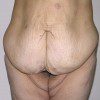 Abdominoplasty 24 Before Photo Thumbnail