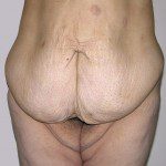 Abdominoplasty 24 Before Photo - 4