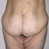 Abdominoplasty 24