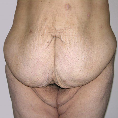 Abdominoplasty 24 Before Photo 