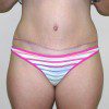 Abdominoplasty 25 Before Photo Thumbnail