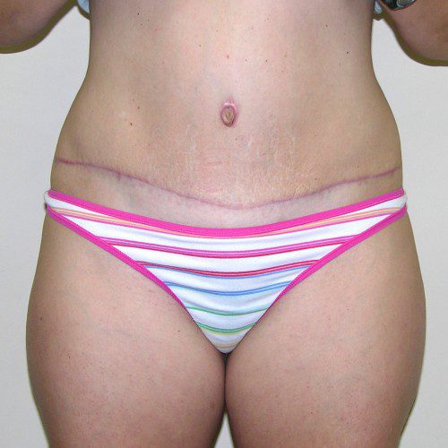 Abdominoplasty 25 Before Photo