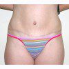 Abdominoplasty 25 After Photo Thumbnail