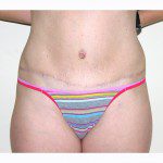 Abdominoplasty 25 After Photo - 4