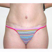 Abdominoplasty 25