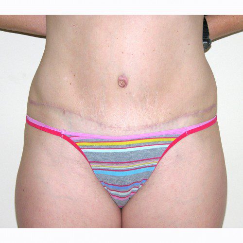 Abdominoplasty 25 After Photo 