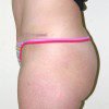 Abdominoplasty 25 After Photo Thumbnail