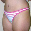 Abdominoplasty 25 After Photo Thumbnail